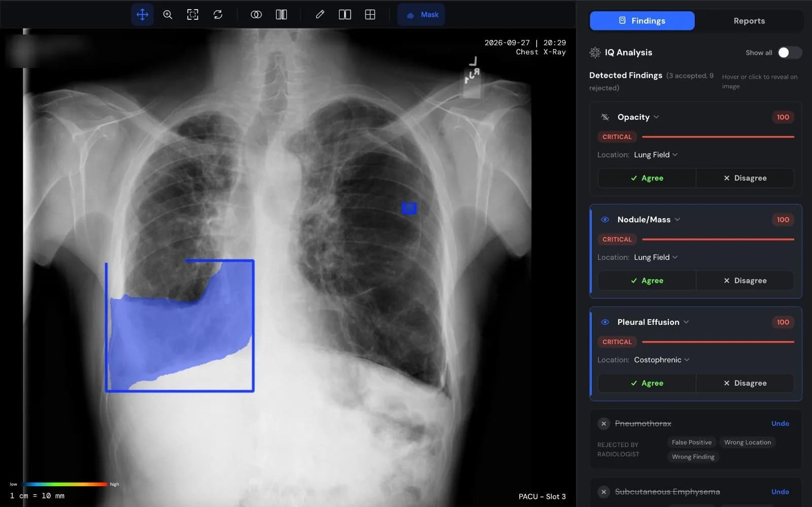 Chest IQ viewer: a chest X-ray with a highlighted finding, beside a panel of detected findings to agree or disagree with