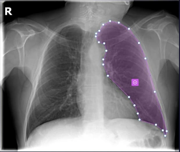 Chest IQ segmentation overlay on a chest X-ray