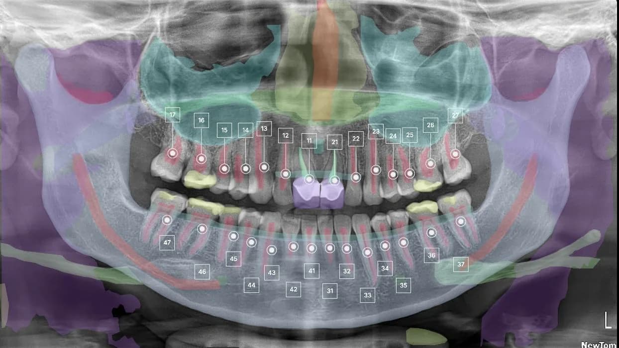 Dental IQ panoramic X-ray with numbered teeth and coloured overlays for anatomy and findings