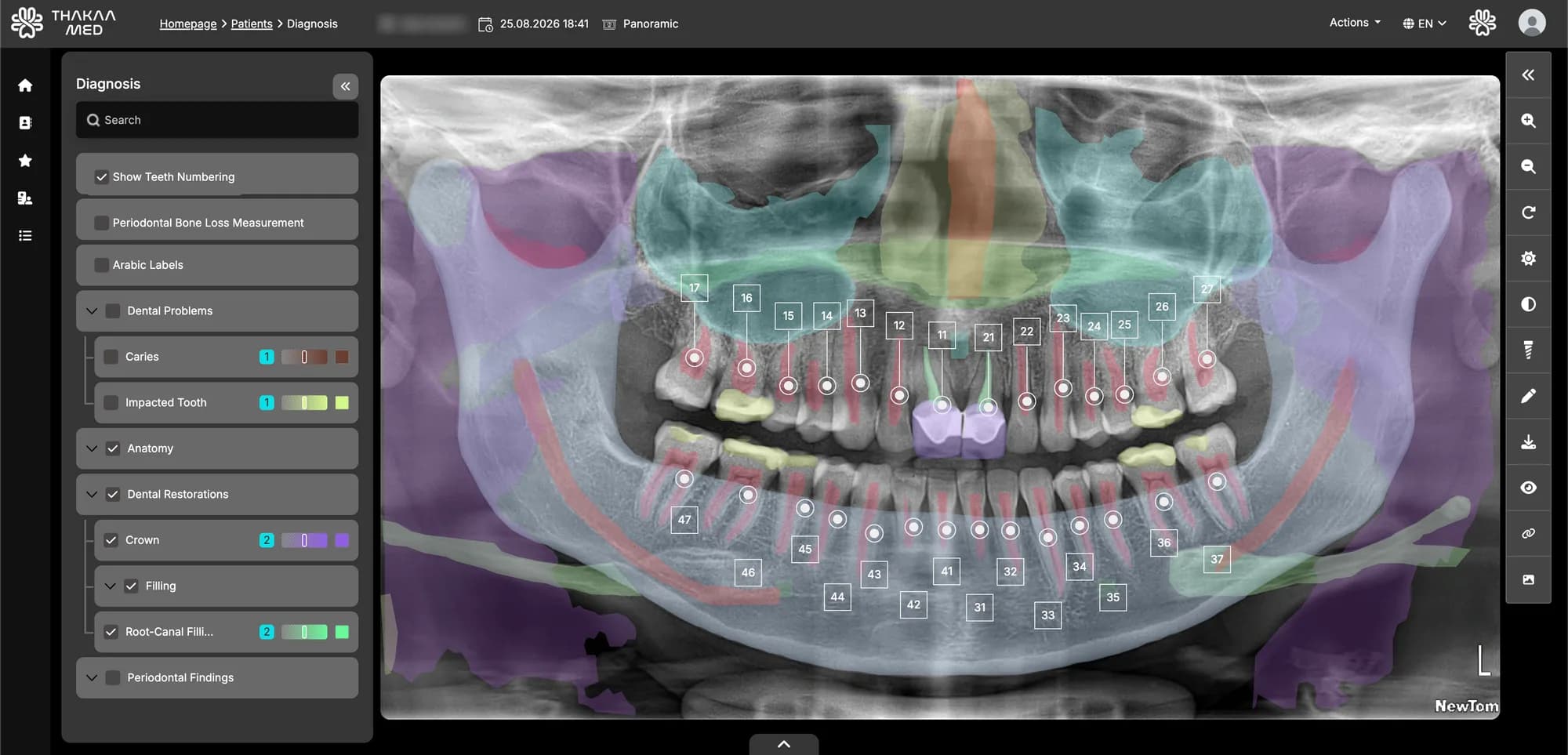 Dental IQ diagnosis view: a panoramic X-ray with numbered teeth and coloured overlays for anatomy, dental problems and restorations, beside a panel of layers to show or hide.
