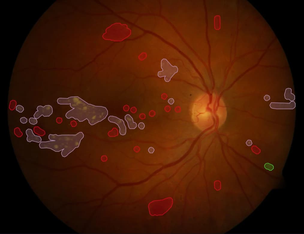 Retina IQ fundus analysis with diabetic retinopathy markers