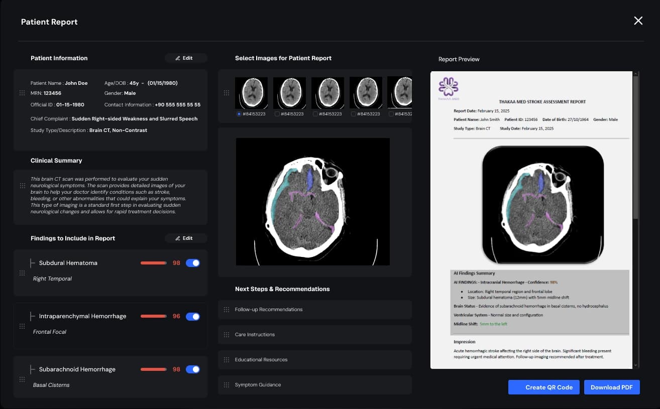 Stroke IQ CT scan with AI-detected ischemic region